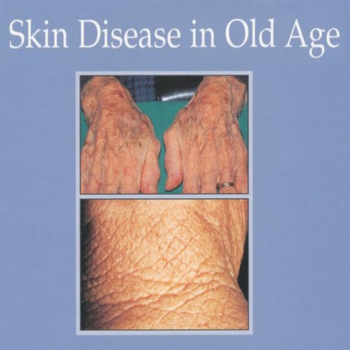Skin Disease in Old Age information and news