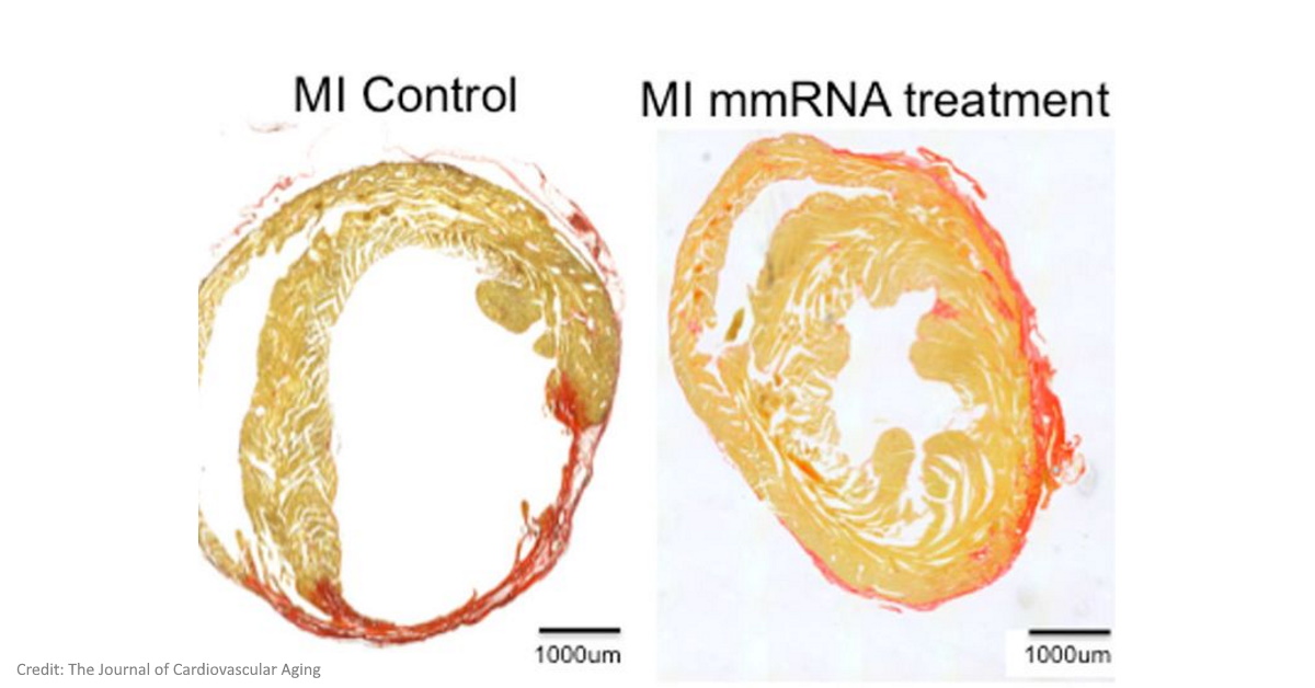 mRNA delivers mutated proteins - regenerates cardiomyocytes post a heart attack