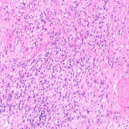 More Inflammaging information, news and resources
