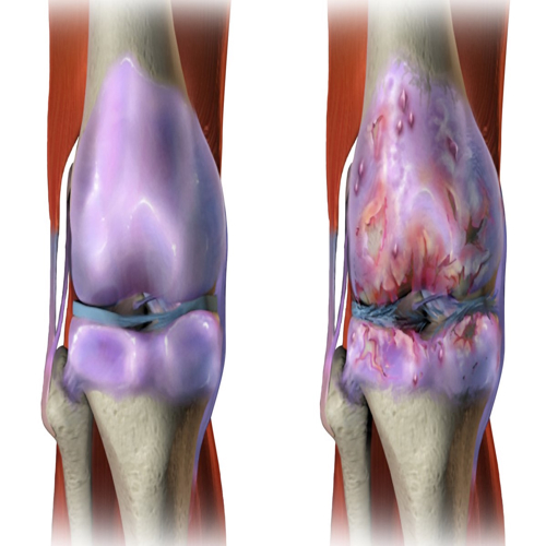 Combination of two molecules, a potential treatment for osteoarthritis