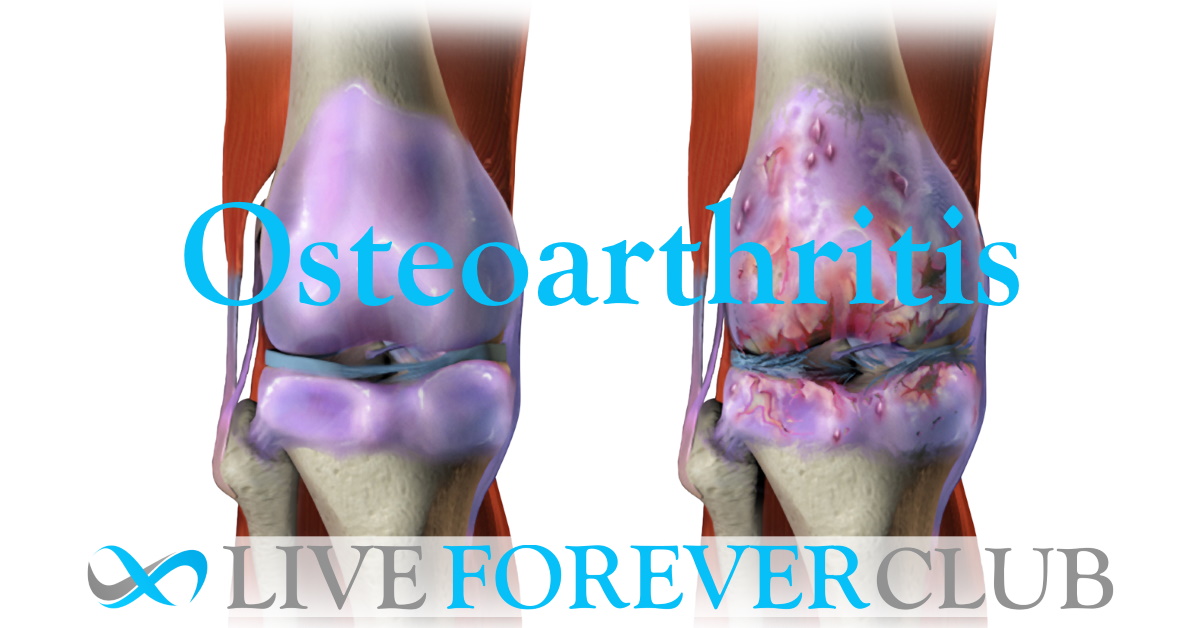 Osteoarthritis