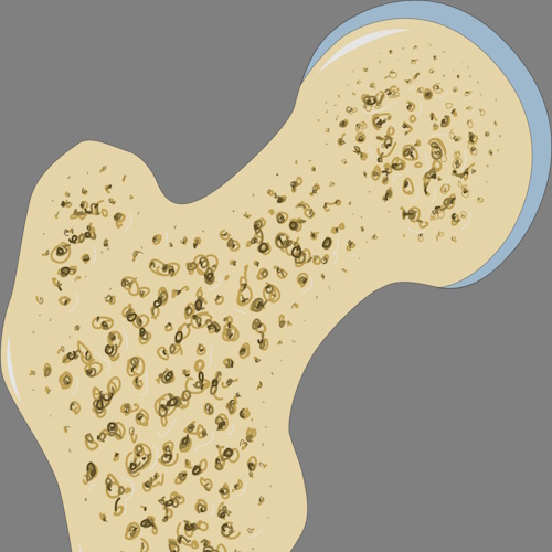 More Osteoporosis information, news and resources