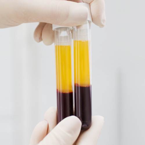 Group of Russian biohackers perform the first human plasma dilution