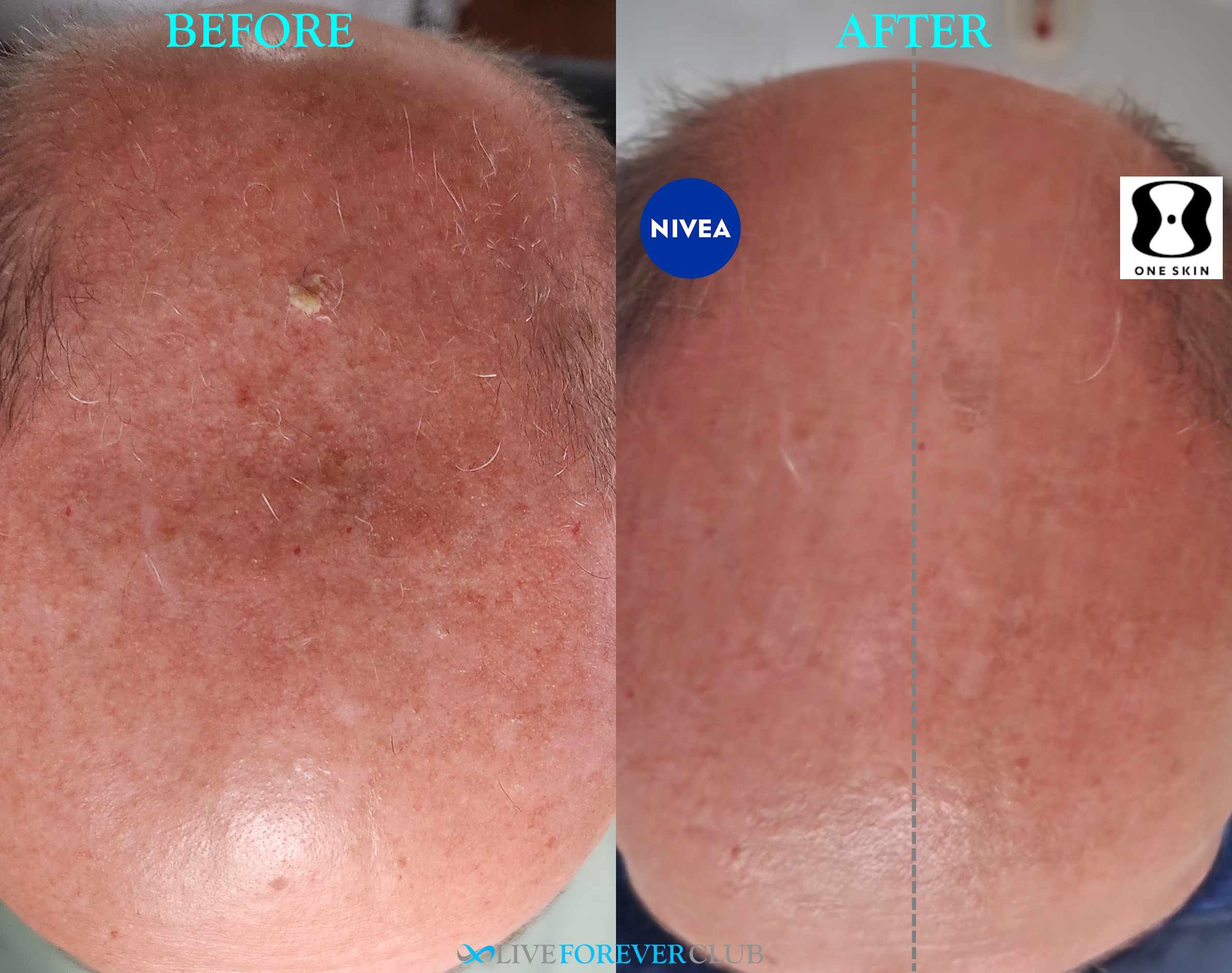 OneSkin head trial comparison