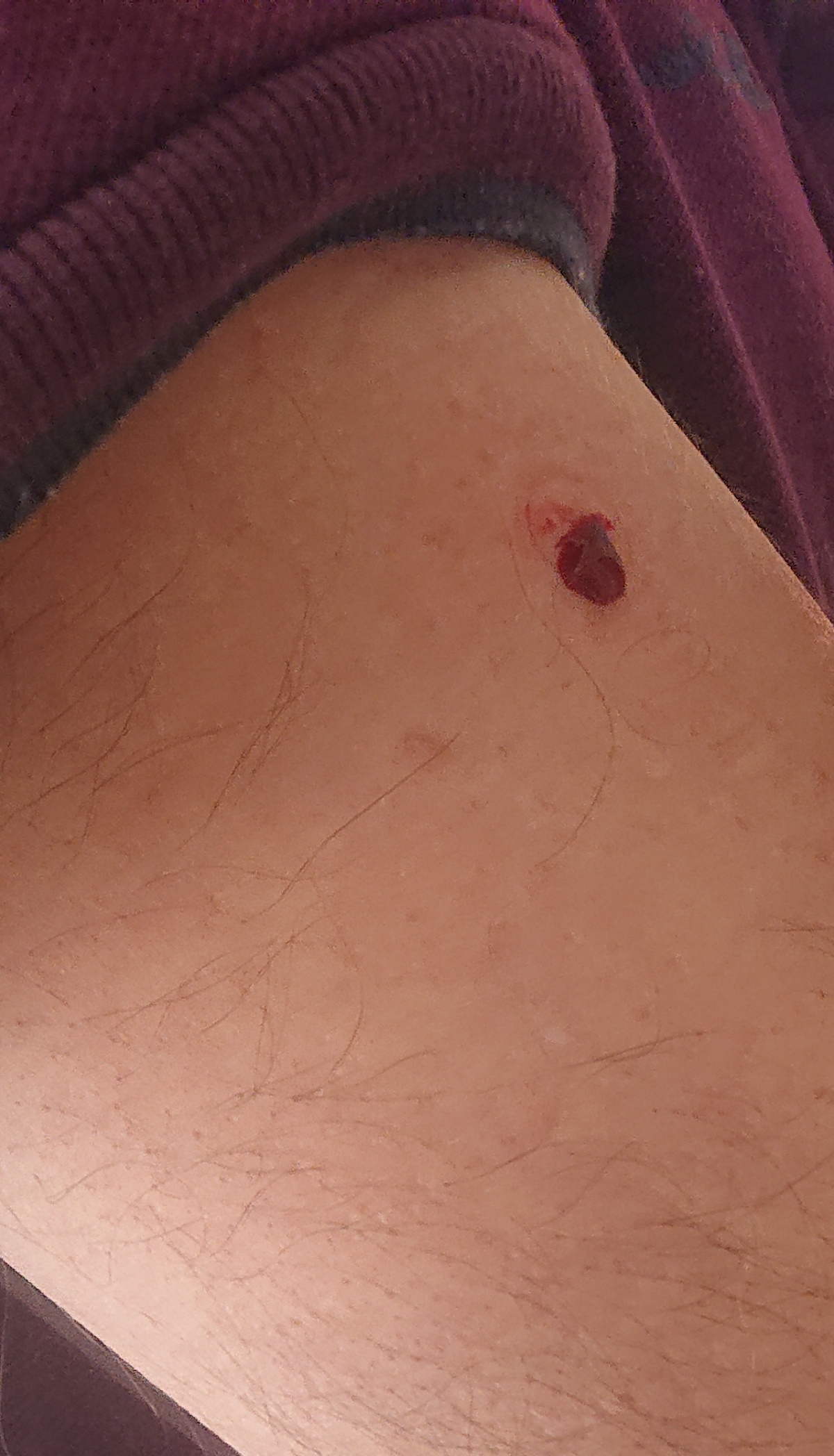 TruDiagnostic Tasso failed arm