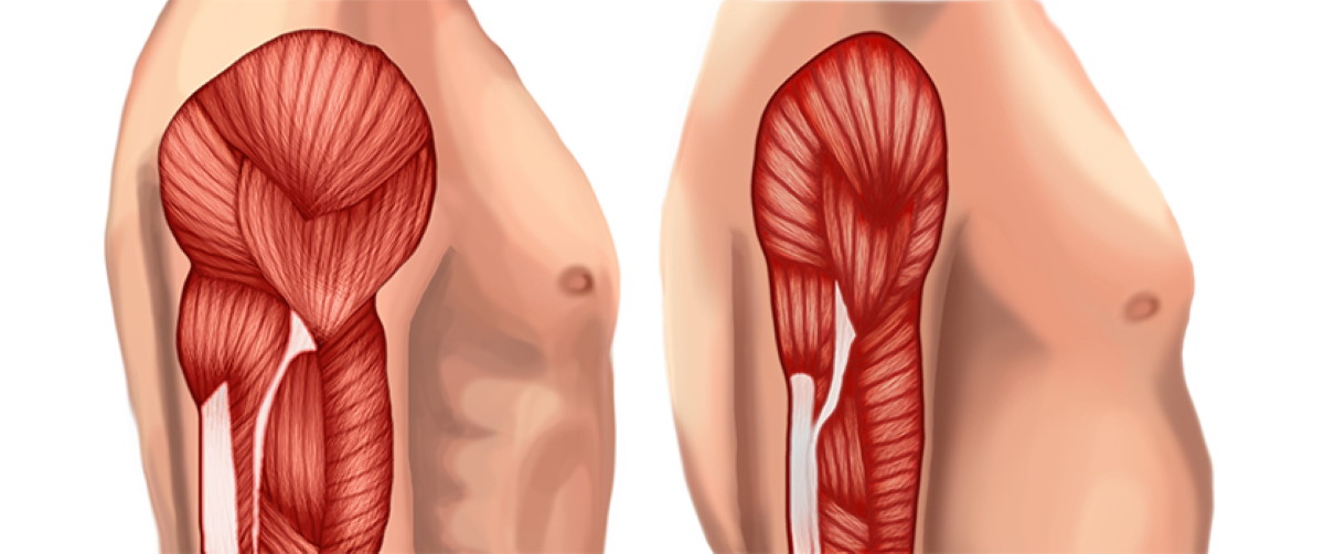 sarcopenia arm muscle loss