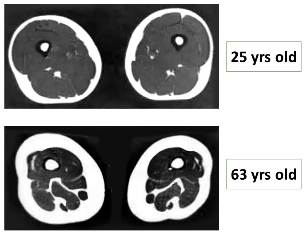 sarcopenia thigh muscle loss MRI scan
