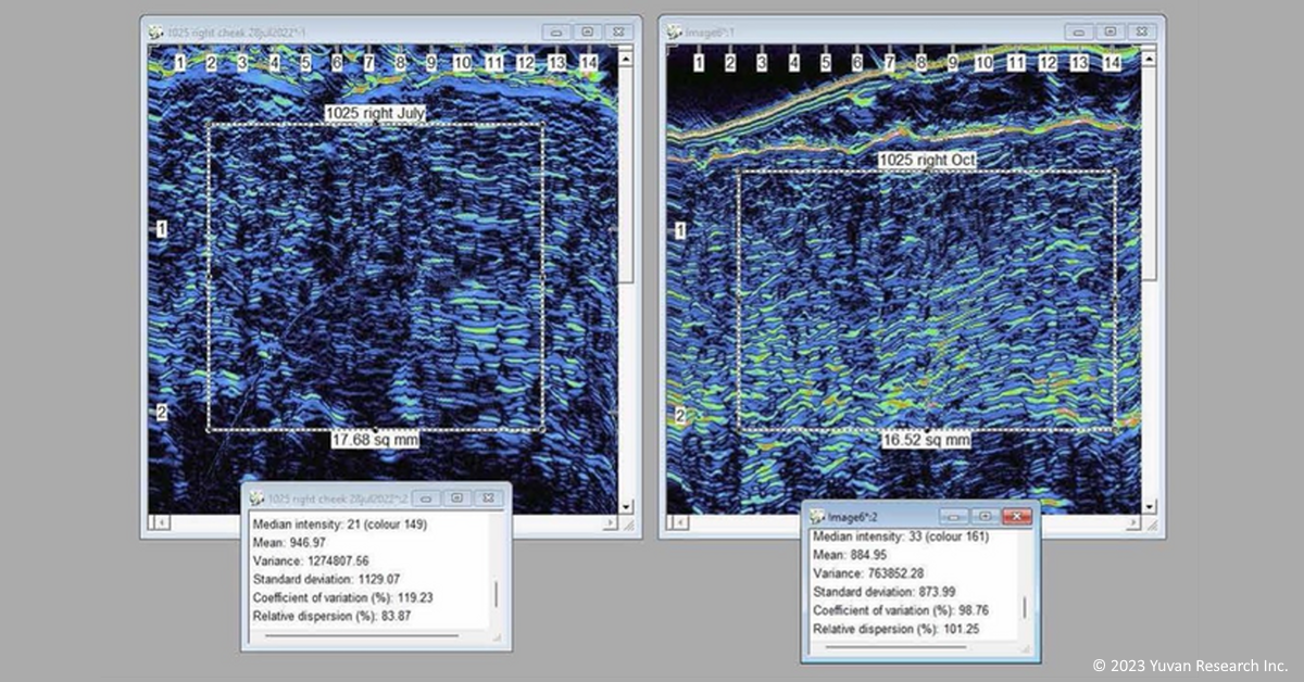 high-resolution dermal ultrasound scan of Neel gel trial participant