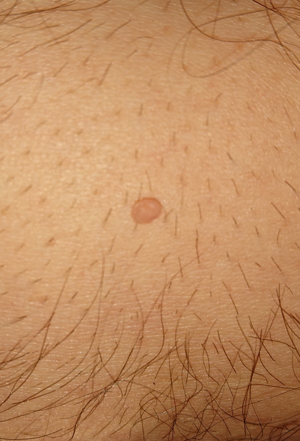skin spot on stomach