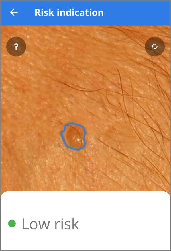 SkinVision app highlighted spot