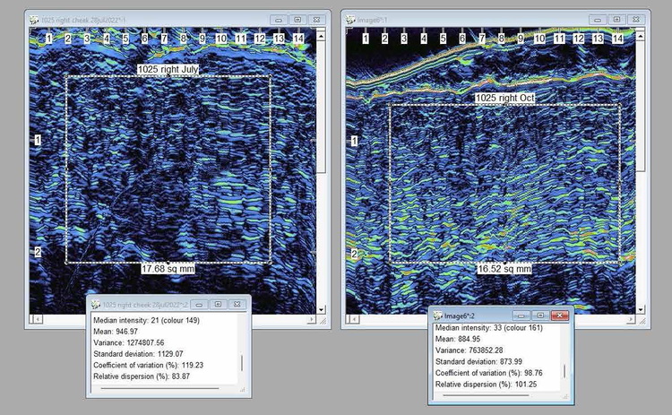 neel gel dermal ultrasound 3-months treatment comparison